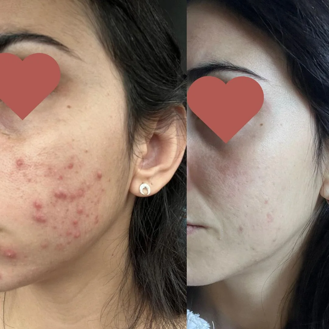 Resultado antes e depois do Método Livre de Acnes